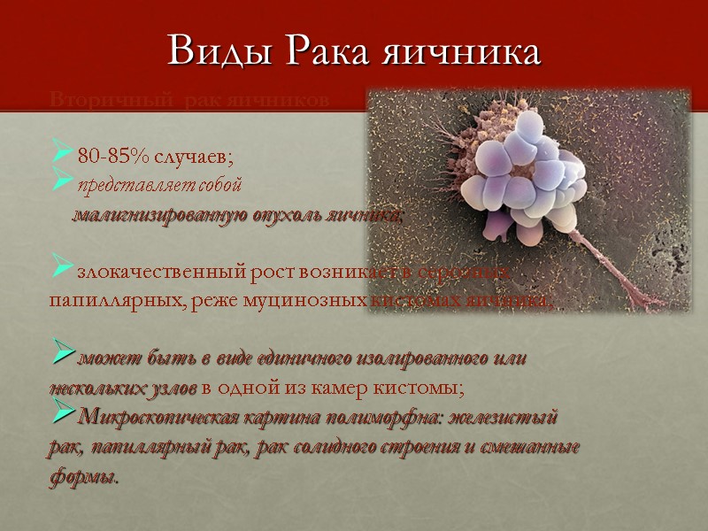Виды Рака яичника Вторичный  рак яичников  80-85% случаев; представляет собой  